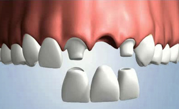 VernonSmiles Dental bridge service