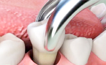 VernonSmiles Dental Tooth Extractions service