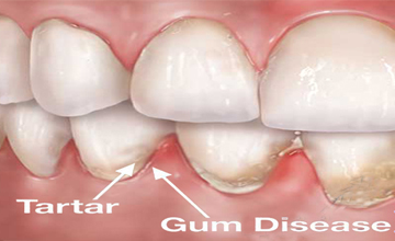VernonSmiles Dental Periodontal (Gum) Disease service