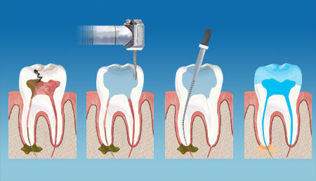 VernonSmiles Dental Endodontics Therapy service